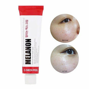 melasma

melanon

creme clareador

clarear melasma

CLAREADOR MANCHAS

acne